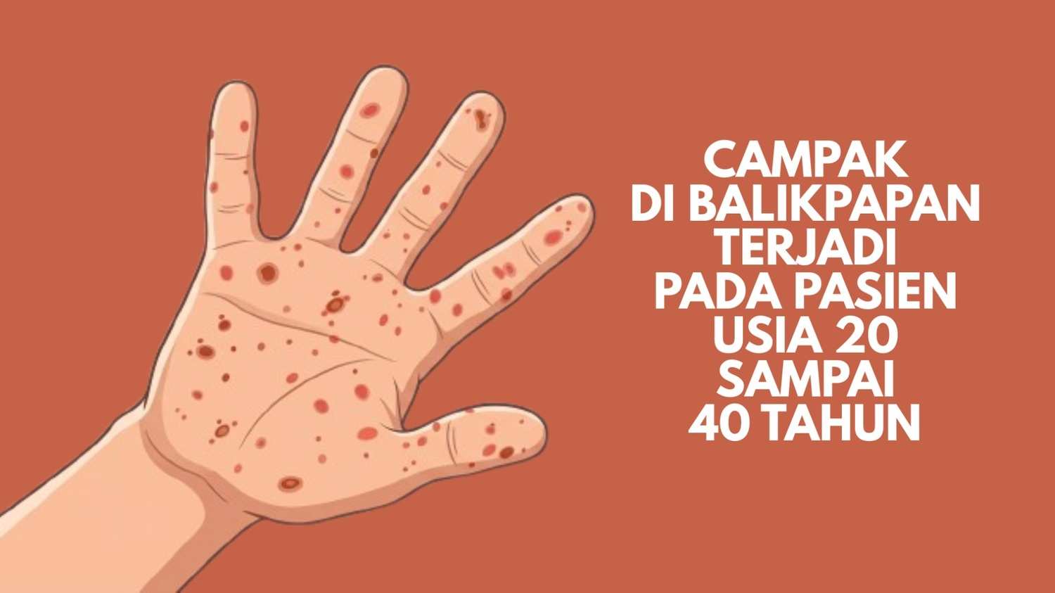 Campak di Balikpapan Terjadi pada Pasien Usia 20 sampai 40 Tahun