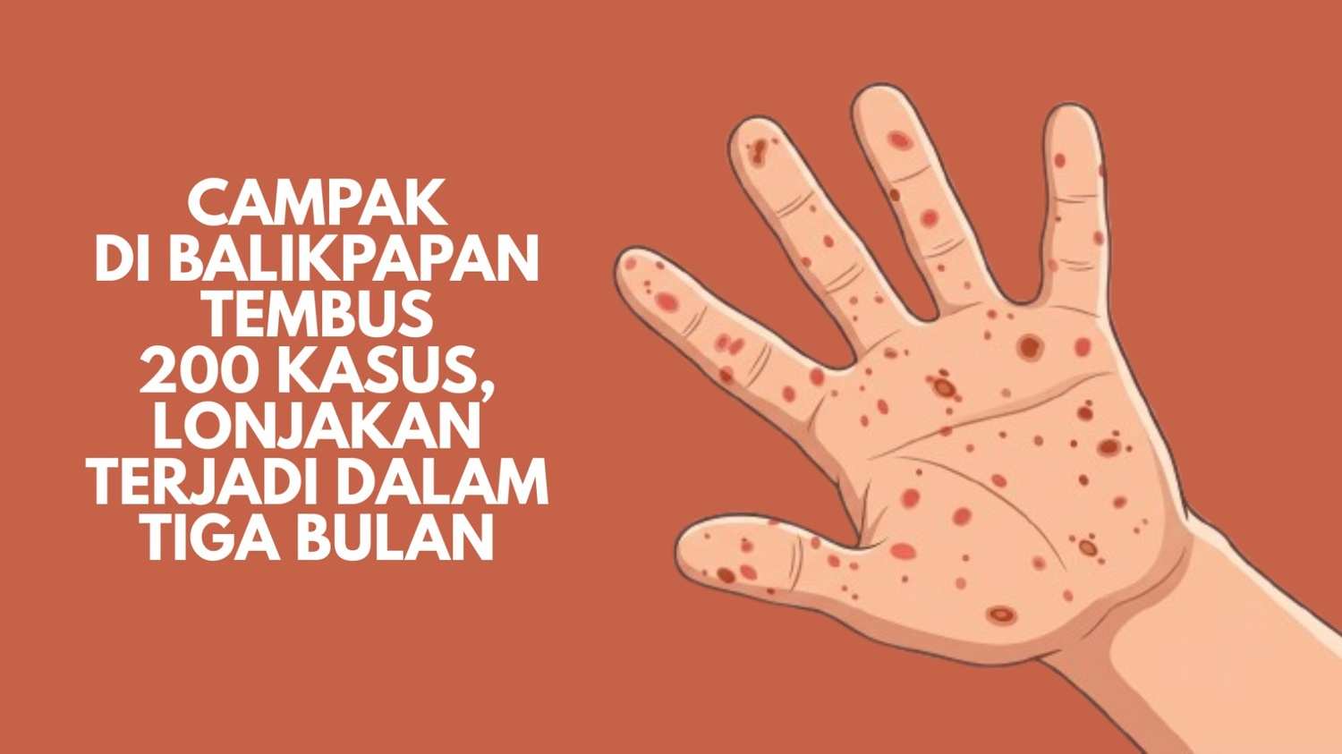 Campak di Balikpapan Tembus 200 Kasus, Lonjakan Terjadi dalam Tiga Bulan