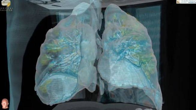 VIDEO: Begini Nih Penampakan Paru-paru yang Diserang Virus Corona